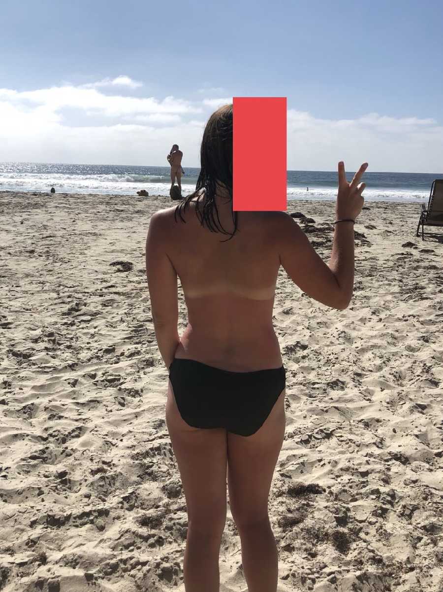 Burnt at the Nude Beach