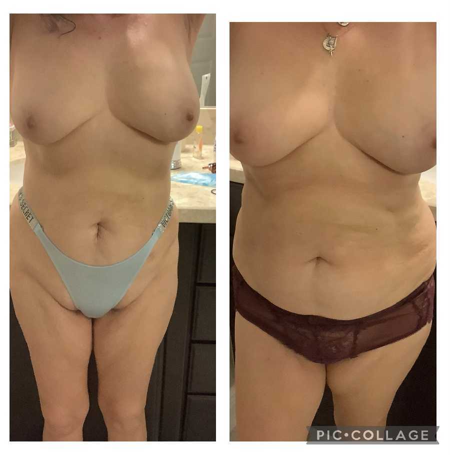 Before and after Diet Pics Naked MILF